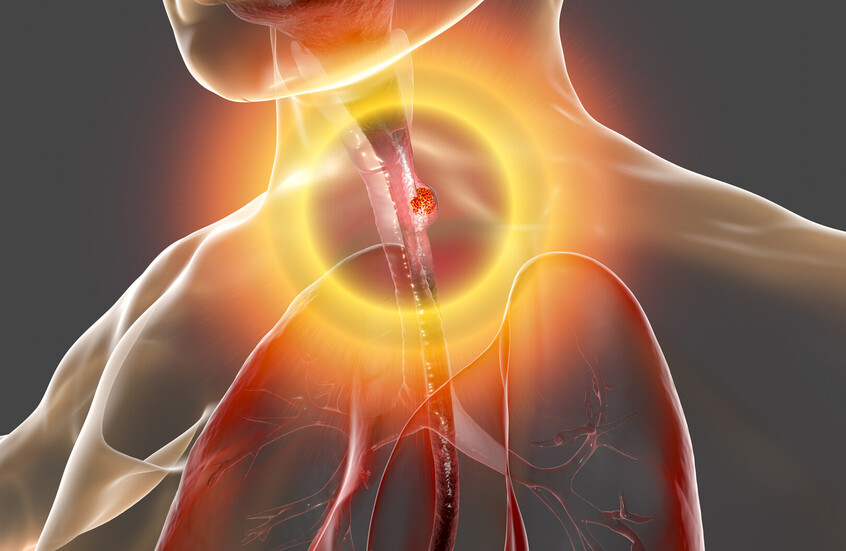 اكتشاف علامة خفية لأحد أخطر أنواع السرطان