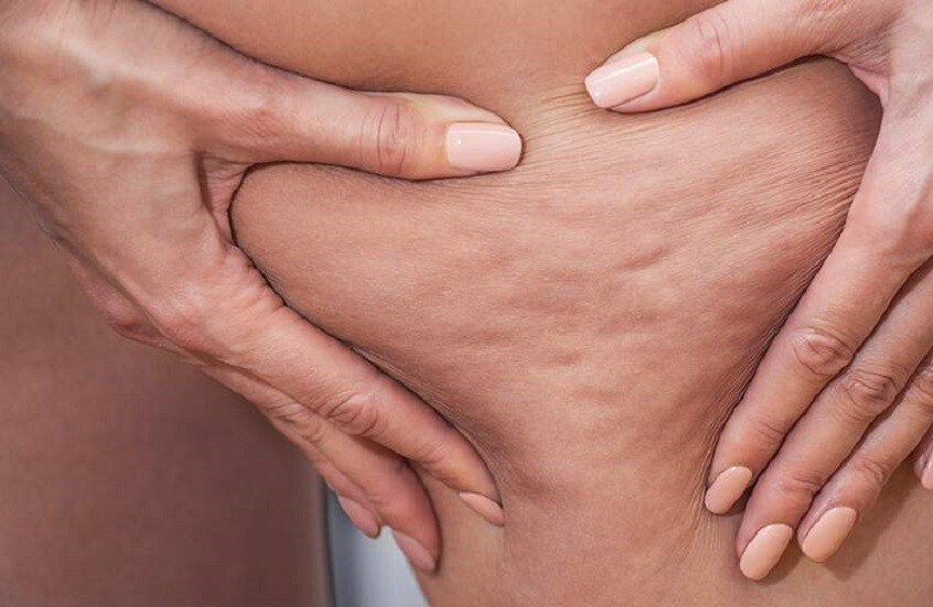 أطعمة تحفز التهاب الأنسجة تحت الجلد.. وبدائلها المفيدة