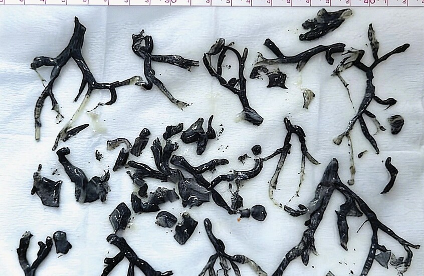 "أغصان سوداء" في رئتيه!.. رجل يصاب بحالة نادرة بعد استنشاقه لدخان الحرائق