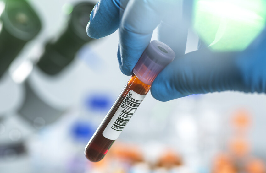 فحص دم روتيني قد يكشف خطر ألزهايمر قبل سنوات من ظهور اﻷعراض