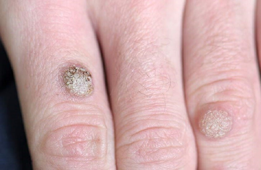 أكثر من 100 سلالة.. فيروس الورم الحليمي البشري بين العدوى الصامتة وخطر الإصابة بالسرطان