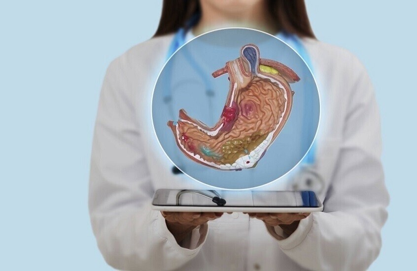 أطعمة تسبب قرحة المعدة