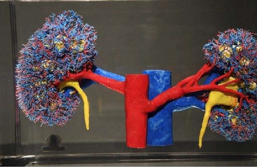 أطعمة تسبب حصى المسالك البولية