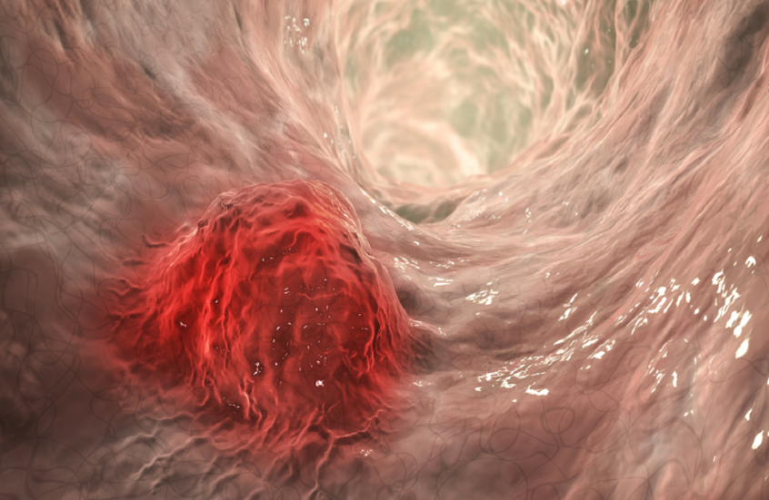 أطعمة تعزز دفاعات الجسم ضد السرطان