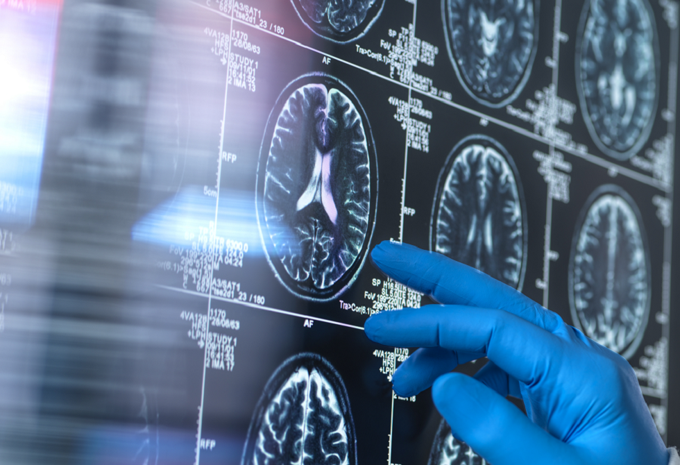 قبل فقدان الذاكرة.. إشارات خفية تكشف الإصابة بالخرف