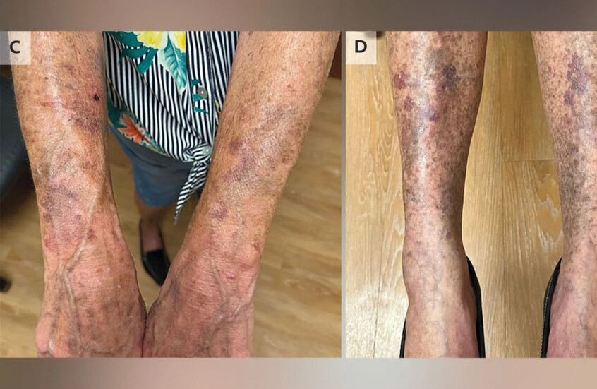 بقع زرقاء وسوداء تغزو جسد امرأة بعد أسابيع من استخدامها مضاد حيوية شائعا