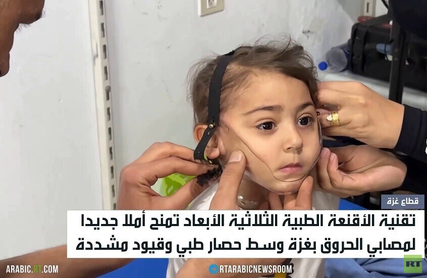 أقنعة ثلاثية الأبعاد لعلاج مصابي الحروق