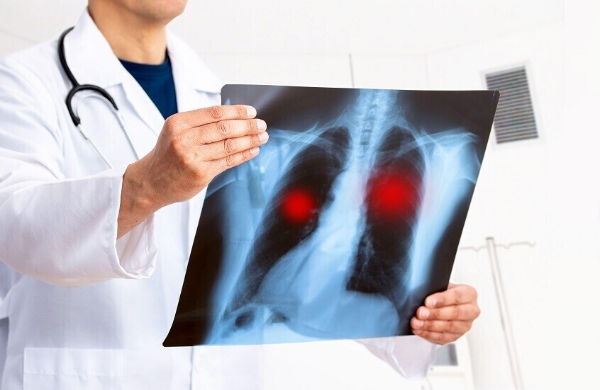 حمية غذائية تقلل خطر الوفاة بسرطان الرئة