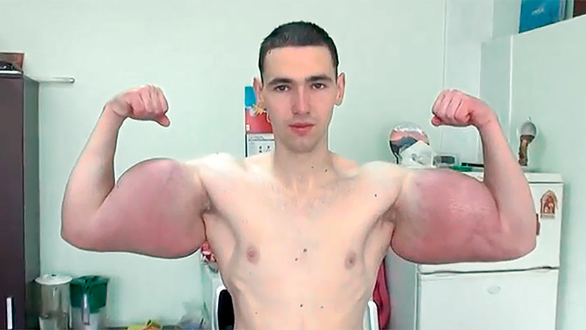 This guy's appearance after Synthol Injections : r/oddlyterrifying