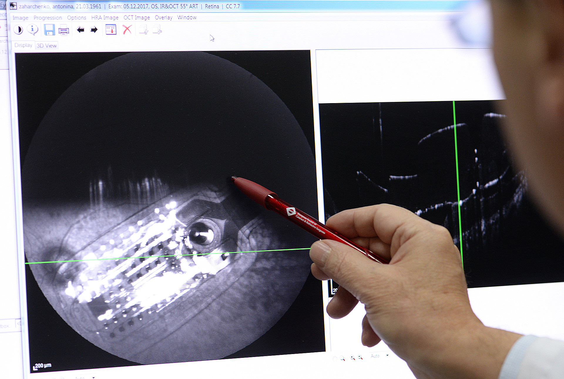 Током операције се у жуту мрљу, централни део мрежњаче, уграђује микрочип и пацијент је у стању да види слику у пикселима.