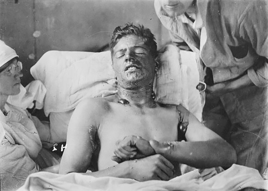 Gas-burned patient in the hospital.