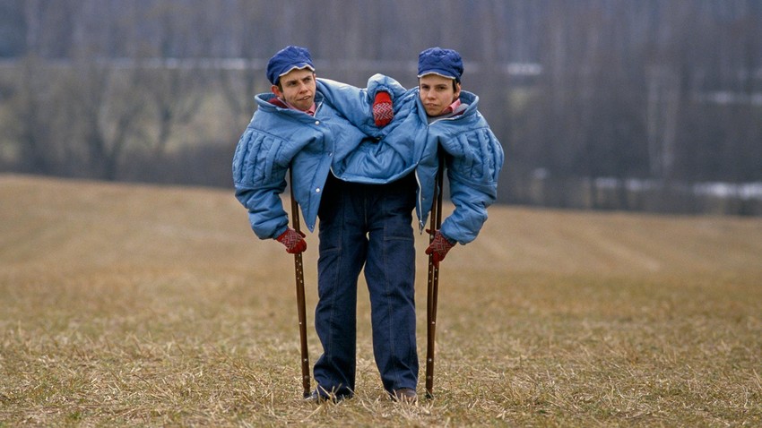 Russian Conjoined Twins Masha And Dasha Krivoshlyapova In Moscow