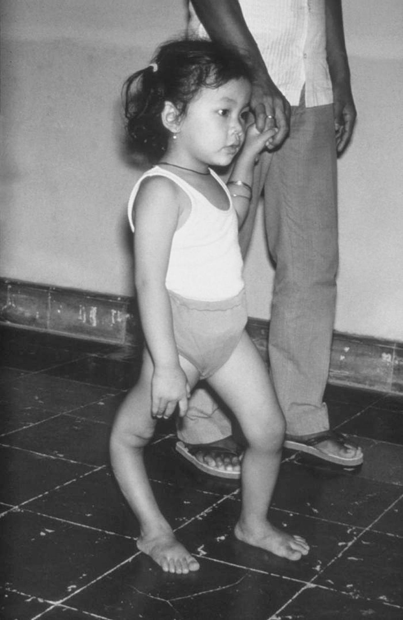 Une fille avec une déformation de sa jambe droite due à la poliomyélite 