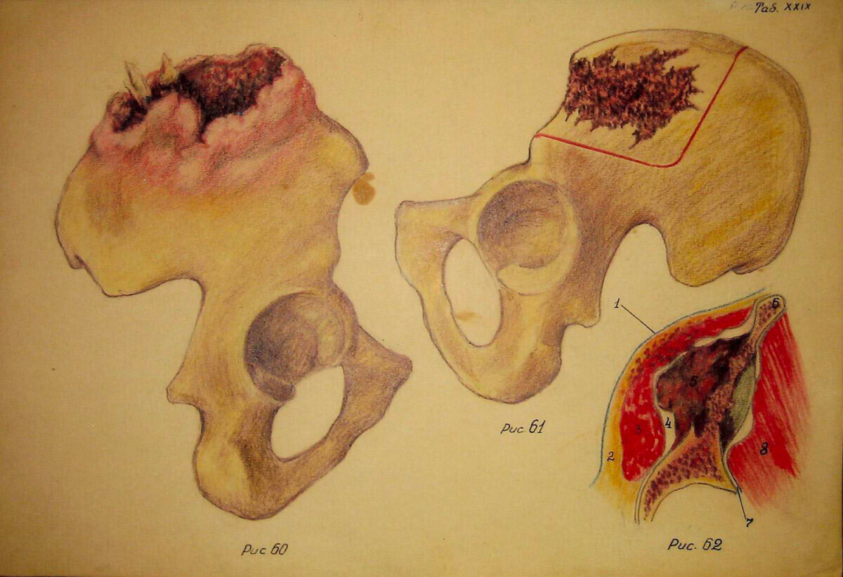 Ilustrações do autor para “Ensaios sobre Cirurgia Purulenta”
