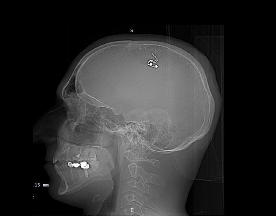 Der Scan von Michails Schädel mit Elektroden im Inneren.