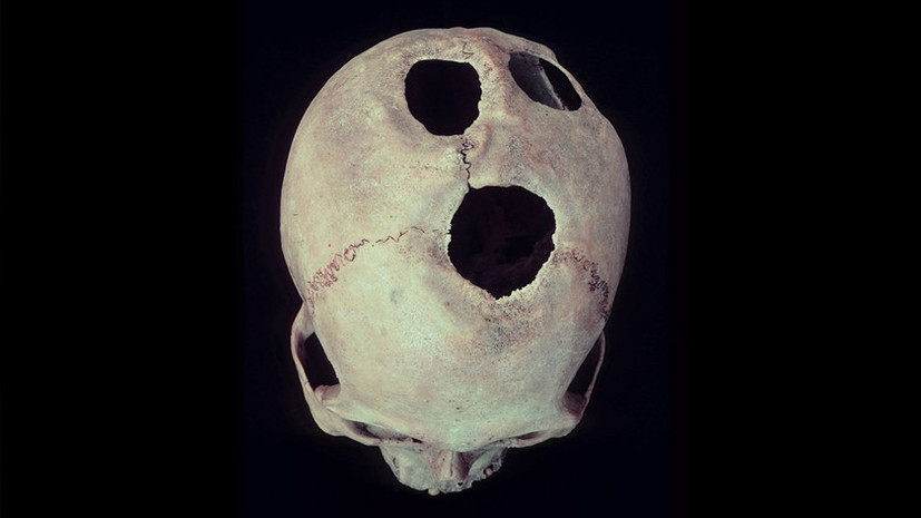 Подход с головой: древние медики успешно проводили трепанацию черепа