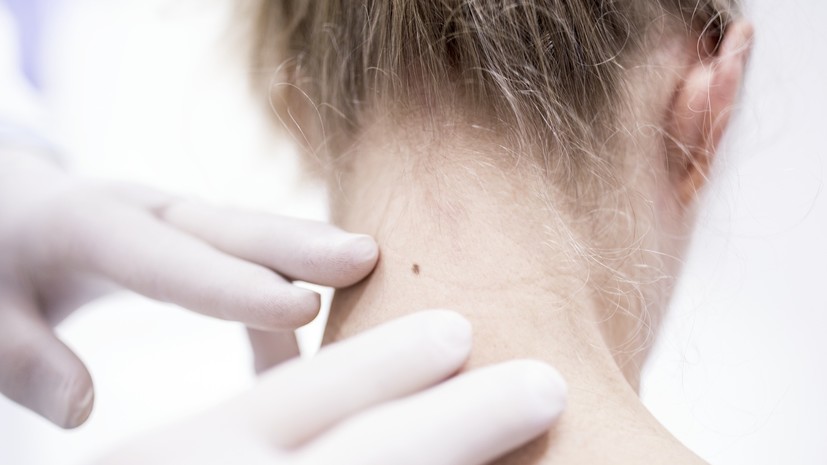 Дерматовенеролог Старицын рассказал о рисках при травмировании родинки