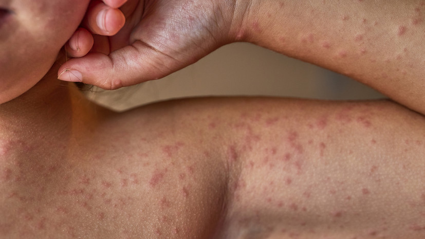 Дерматолог Галлямова рассказала о возможных аллергических реакциях после коронавируса