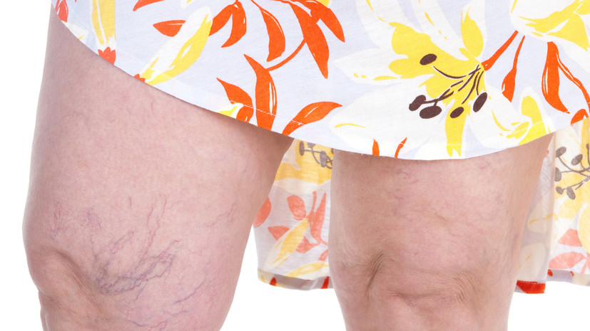 Флеболог Авакян порекомендовал пациентам с варикозом избегать солнца