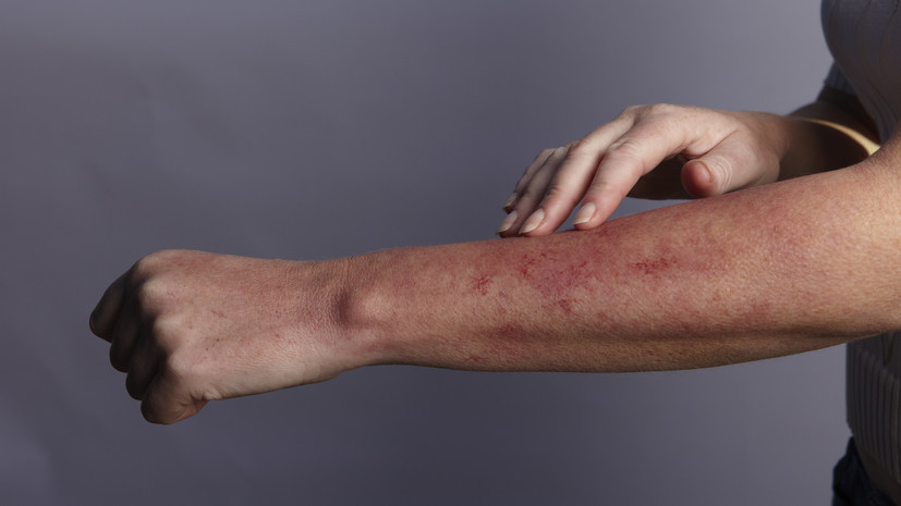 Доктор медицинских наук Галлямова рассказала, что нельзя делать после солнечного ожога