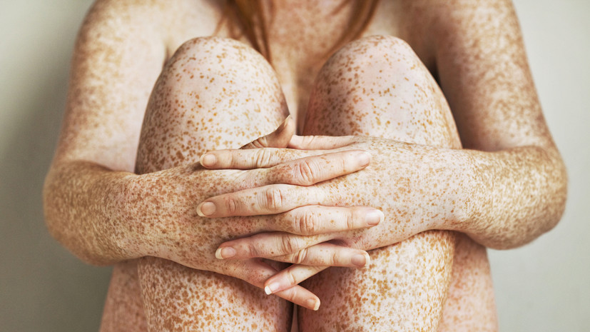 Врач Самойленко посоветовал обратить внимание на появившиеся у взрослого веснушки