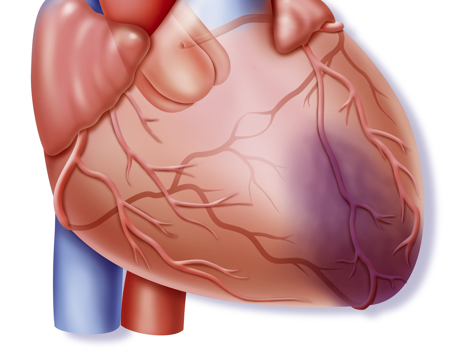 Ишемия мышц. Гейщит инфаркт. Сердце после инфаркта миокарда.
