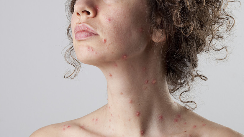 Иммунолог Болибок заявил, что можно заболеть ветрянкой повторно