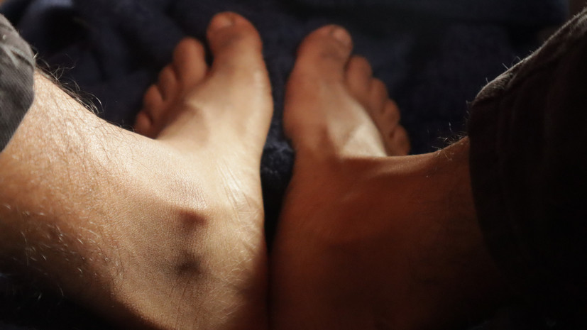 Lancet: из-за длительного коронавируса у мужчин может меняться цвет ног