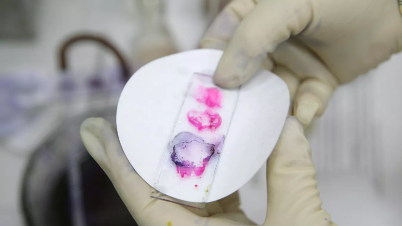 У подростка в Воронежской области подтвердили сибирскую язву