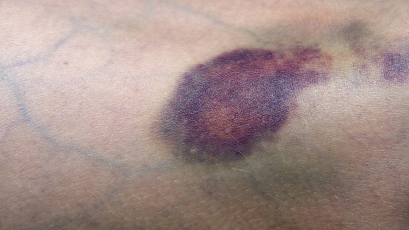 Врач Ломова назвала синяки одним из неочевидных признаков болезни печени