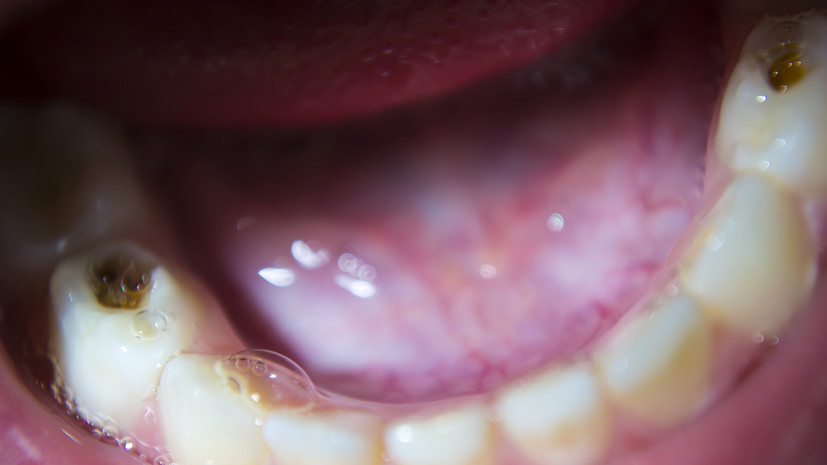 Стоматолог Мартынова: из-за невылеченного кариеса может развиться эндокардит