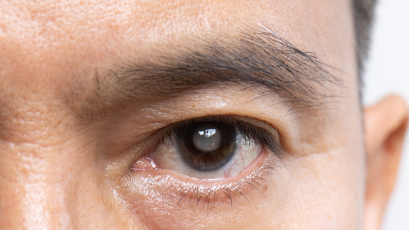 Врач Курачинова назвала основные причины развития катаракты