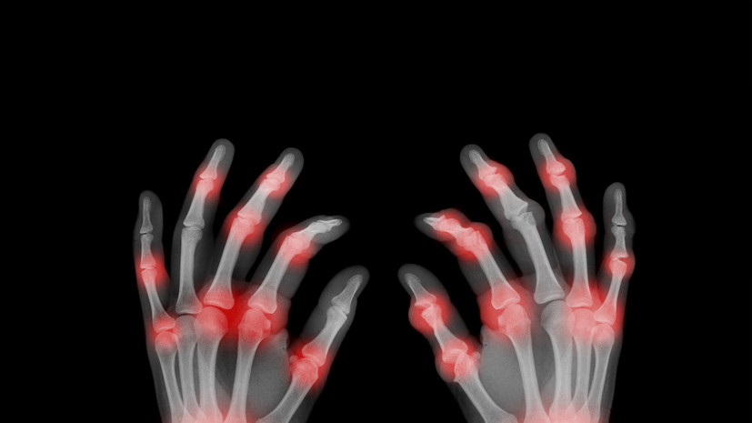 Врач Ефремкин: ревматизм всё чаще диагностируют у молодых