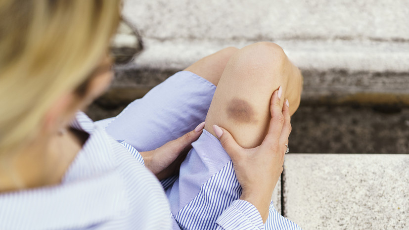 Врач Вастистова рассказала о причинах появления синяков на теле