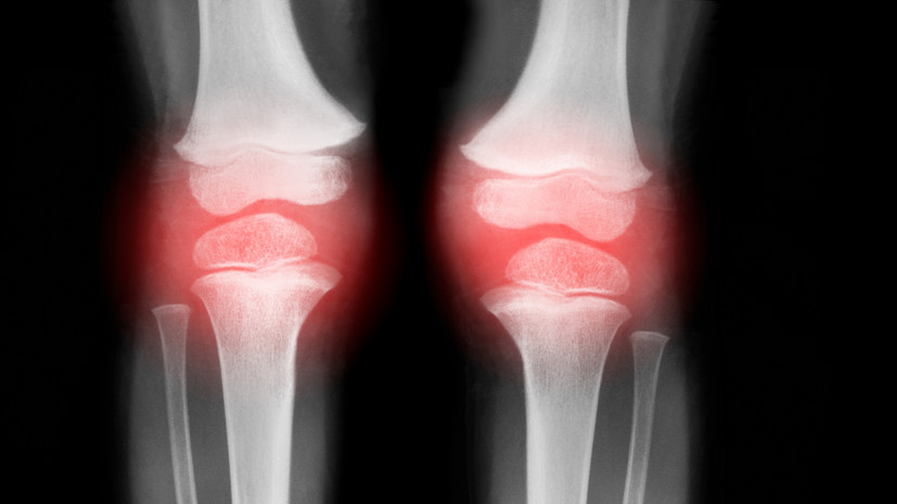 Врач назвал малоподвижный образ жизни причиной «омоложения» заболеваний суставов