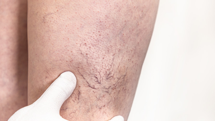 Врач Ставцев рассказал о причинах появления сосудистых звёздочек