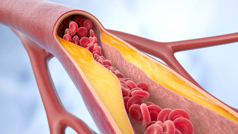 Врач Золотарёва: в большинстве случаев можно избежать последствий атеросклероза