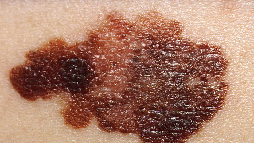 Врач Зимина рассказала, как распознать злокачественные родинки