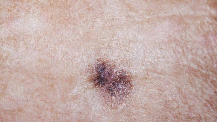 Онколог Батухтина рассказала, как заметить перерождение родинки в злокачественное новообразование