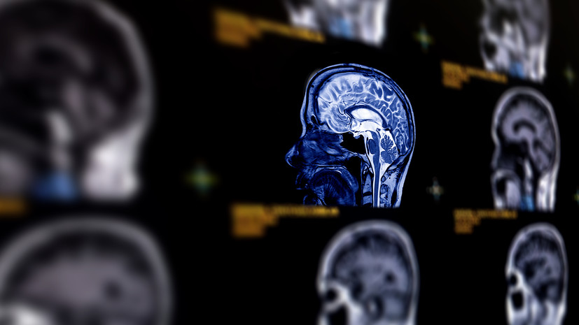 Врач Орлов: проблемы с памятью могут быть признаком аневризмы головного мозга