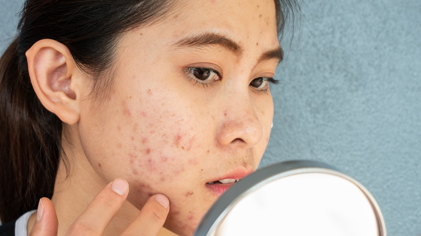 Диетолог Кливитская: кофеиносодержащие напитки и быстрые углеводы вызывают акне