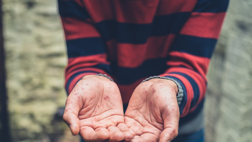 Онищенко призвал россиян воздержаться от поездок в Турцию из-за вируса Коксаки