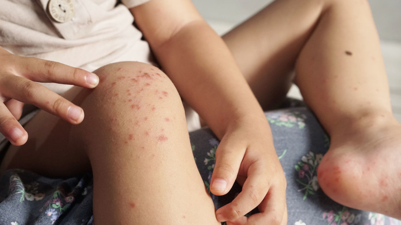 Вирусолог Нетёсов: вызываемая вирусами Коксаки болезнь случается каждый год в разных странах мира