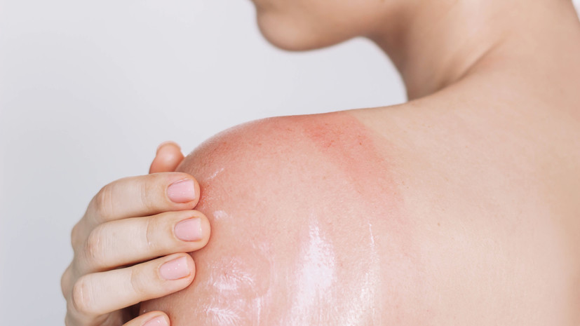 Дерматолог Гришина: при солнечном ожоге нельзя мазать кожу сметаной и кефиром