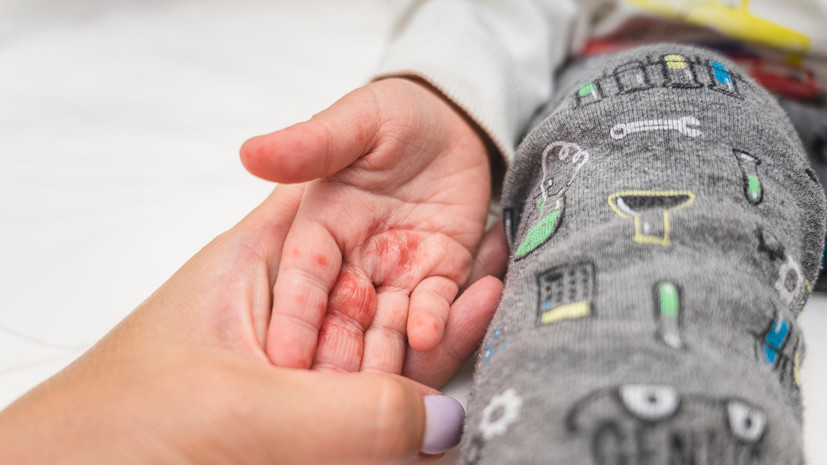 Врач объяснил, чем опасен вирус Коксаки и кто в группе риска