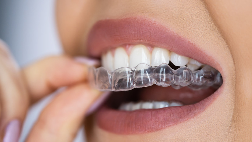 Врач Буторина рассказала об отличиях брекетов от элайнеров