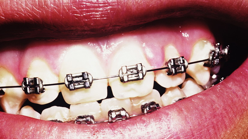 Ортодонт Диденко назвала эндокринные заболевания возможным противопоказанием к брекетам