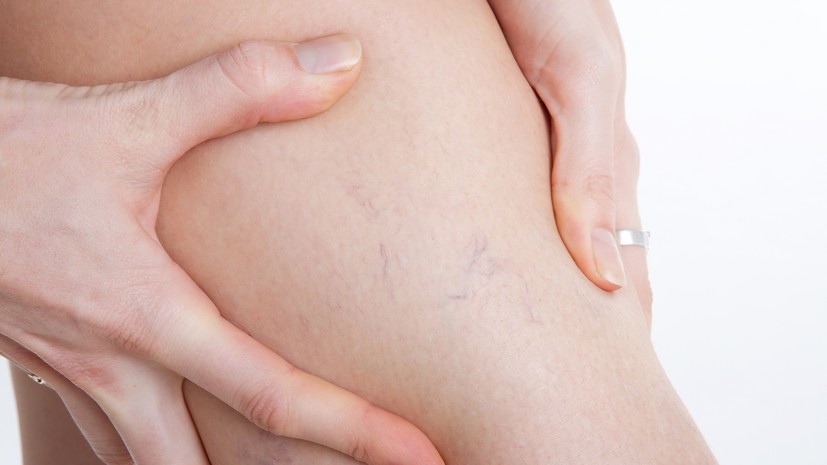 Врач: появление сосудистых звёздочек может говорить о тромбозе глубоких вен