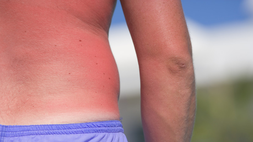 Онколог Самойленко напомнил об опасности солнечных ожогов