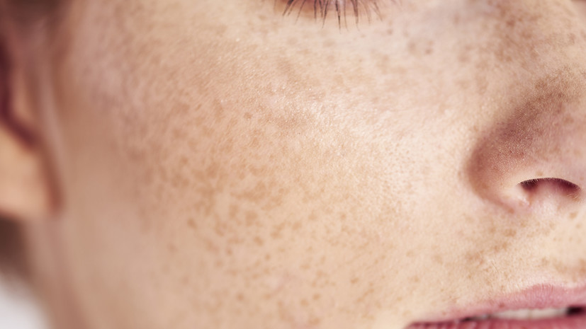 Врач Матвеева рассказала, как формируются веснушки